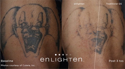 Rogue - tattoo Removal for men 1